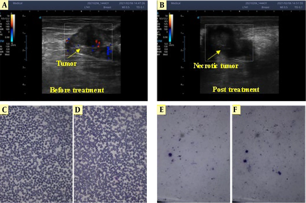 Doppler ultrasonography enables live monitoring during the treatment process. Due to Doppler ultrasonography, before electrochemical therapy (EChT), blood flow to the tumor (that feeds the tumor) can be seen (A); but after EChT, it is almost stopped; and there is no blood flow to the tumor so the tumor is not being fed by blood (B); Smearing of whole blood cells (C and D); and white blood cells (E and F) before and after the treatment, respectively, with two platinum needle electrodes. No significant change was observed in the smear samples before and after the treatment. Doppler ultrasonography enables live monitoring during the treatment process. Due to Doppler ultrasonography, before electrochemical therapy (EChT), blood flow to the tumor (that feeds the tumor) can be seen (A); but after EChT, it is almost stopped; and there is no blood flow to the tumor so the tumor is not being fed by blood (B); Smearing of whole blood cells (C and D); and white blood cells (E and F) before and after the treatment, respectively, with two platinum needle electrodes. No significant change was observed in the smear samples before and after the treatment.