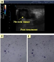 Real-time Monitoring of Peripheral Blood After Electrochemical Therapy by Electrical Impedance Spectroscopy: A Clinical Trial Study