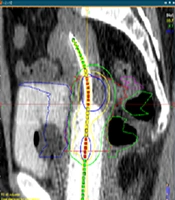 A Comparison of Manual and Automatic Methods for Calculating Cumulative Dose-Volume Histogram Parameters in Cervical Cancer Radiotherapy