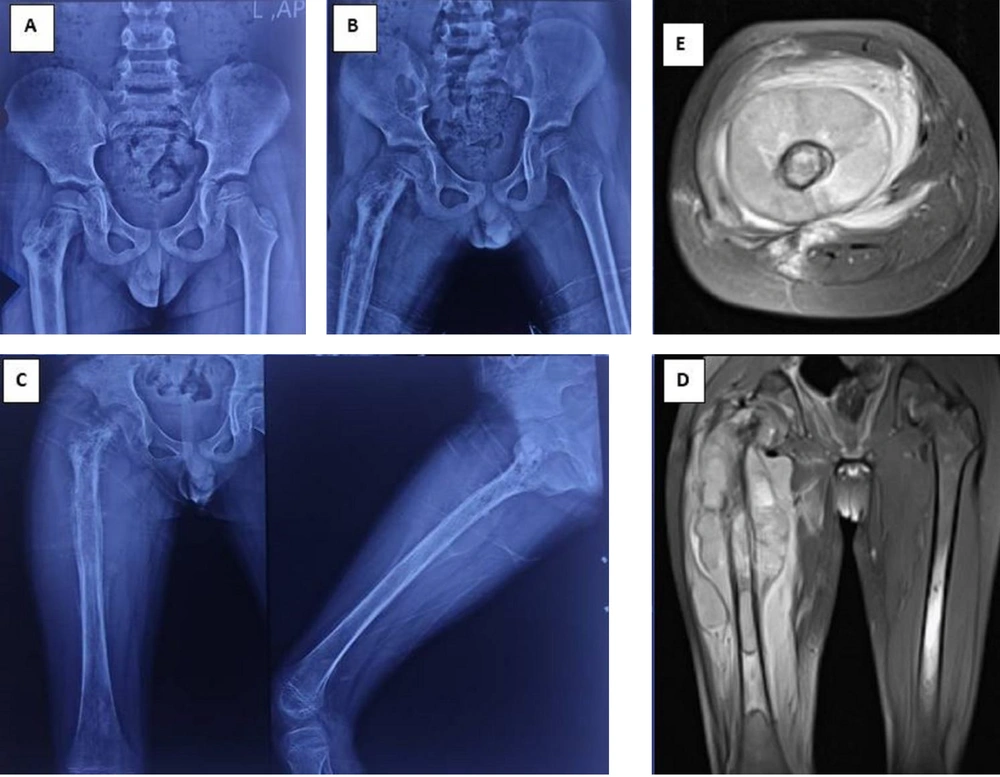 Radiographic and magnetic resonance imaging (MRI) progression of a misdiagnosed case of Ewing's sarcoma. A, initial anteroposterior pelvic radiograph obtained 9 months prior to definitive diagnosis, demonstrating abnormalities in the proximal right femur. The patient presented with pain, limping, and low-grade fever, initially diagnosed and treated as acute osteomyelitis; B, follow-up radiograph 5 months prior to definitive diagnosis, showing disease progression despite symptomatic improvement. Surgical debridement was performed, with pathology suggesting infection, although cultures remained negative; C, radiograph at presentation to our tertiary center, revealing further progression of the lesion; D and E, coronal and axial MRI sequences, respectively, obtained at our center on the day of definitive diagnosis. Subsequent biopsy results confirmed Ewing's sarcoma. Radiographic and magnetic resonance imaging (MRI) progression of a misdiagnosed case of Ewing's sarcoma. A, initial anteroposterior pelvic radiograph obtained 9 months prior to definitive diagnosis, demonstrating abnormalities in the proximal right femur. The patient presented with pain, limping, and low-grade fever, initially diagnosed and treated as acute osteomyelitis; B, follow-up radiograph 5 months prior to definitive diagnosis, showing disease progression despite symptomatic improvement. Surgical debridement was performed, with pathology suggesting infection, although cultures remained negative; C, radiograph at presentation to our tertiary center, revealing further progression of the lesion; D and E, coronal and axial MRI sequences, respectively, obtained at our center on the day of definitive diagnosis. Subsequent biopsy results confirmed Ewing's sarcoma.