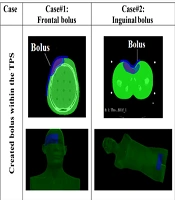 Dosimetric Validation and Surface Fit Evaluation of 3D-Printed Dose Boluses for Radiation Therapy Applications