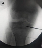 Transepiphyseal Curettage for Centrally Located Chondroblastomas: A Novel Approach with Excellent Functional Outcomes in Pediatric Patients