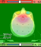 Enhancing Tomotherapy for Brain Tumors: A Noncoplanar Technique with Improved Dosimetric Outcomes