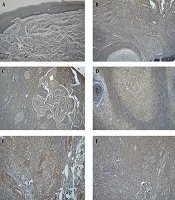 Sonic Hedgehog as a Potential Indicator of Tumor Progression in Tongue Squamous Cell Carcinoma