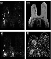 Evaluating Apparent Diffusion Coefficient (ADC) as a Non-invasive Imaging Biomarker for Breast Cancer Prognosis: Correlation with Histopathological and Molecular Biomarkers
