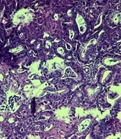 A Rare Case of Synchronous Endometrioid Bilateral Ovarian and Endometrial Adenocarcinoma with Endocervical Involvement