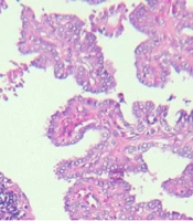Comparative Evaluation of Cyclin D1 Protein Expression in Papillary Thyroid Carcinoma and Follicular Epithelial Dysplasia Associated with Hashimoto’s Thyroiditis