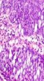 Primary Transitional Cell Carcinoma of Fallopian Tube Mimicking Radiologically as Extrauterine Leiomyoma: A Case Report