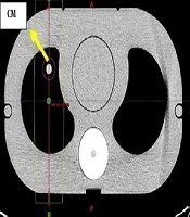 The Effect of Contrast-enhanced Computed Tomography (CT) Scans on the Calculated Dose of Radiotherapy in a Thorax Phantom