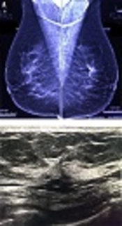 The Outcome of Primary Architectural Distortion in Mammography: Which are the Important Factors?