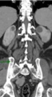 Multifocal Extramedullary and Multiple Solitary Bone Plasmacytoma: A Case Report and Review of the Literature