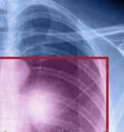 Small Cell Lung Cancer in Good Performance Status: A Mono-Center Tunisian Study