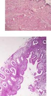 Endometriosis: A Rare Cause of Gross Hematuria