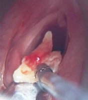 Advantages of Transoral Endoscopic Diode Laser Microsurgery for the Treatment of Early-Stage Glottic Laryngeal Cancers