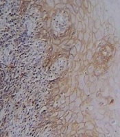Cover image of the article: CD44 Expression in Dysplastic and Non-Dysplastic Oral Lichen Planus