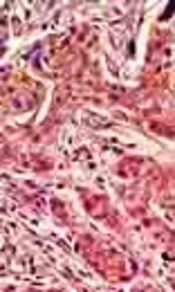 Increased Nuclear Localization of β - catenin by rhBMP - 2 in the Induced Oral Squamous Cell Carcinoma in the Syrian Hamster Cheek Pouch