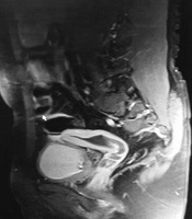 A Rare Case of Persistent Mullerian Duct Syndrome and Review of Literature