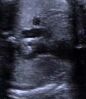 A Case Report of Postpartum Acute Aortic Dissection