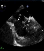 Cover image of the article: Clinical profile of patients with prosthetic heart valve thrombosis undergoing fibrinolytic therapy and NYHA class as a predictor of outcome