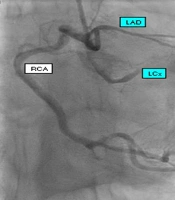 Patient with Purulent Pericardial Effusion Revealing Squamous Cell Lung Carcinoma