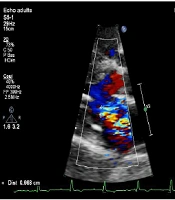 Cover image of the article: Patient with Purulent Pericardial Effusion Revealing Squamous Cell Lung Carcinoma