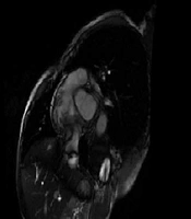 Patient with Purulent Pericardial Effusion Revealing Squamous Cell Lung Carcinoma