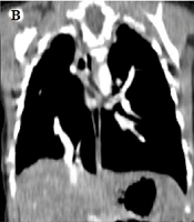 Patient with Purulent Pericardial Effusion Revealing Squamous Cell Lung Carcinoma