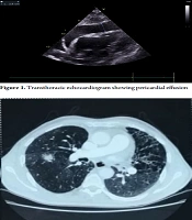 Patient with Purulent Pericardial Effusion Revealing Squamous Cell Lung Carcinoma