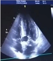 Left Ventricular Torsion Deformation in Atrial Septal Defect Patients Undergoing Transcatheter Device Closure