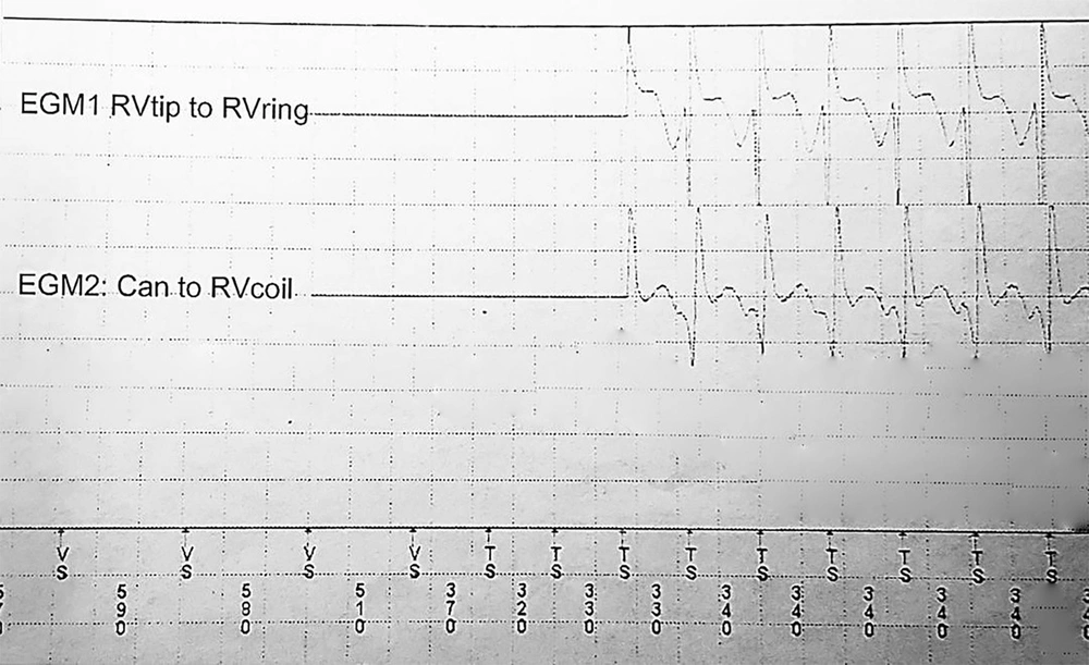 Example of ventricular tachycardia with a Q pattern in the far-field electrogram Example of ventricular tachycardia with a Q pattern in the far-field electrogram