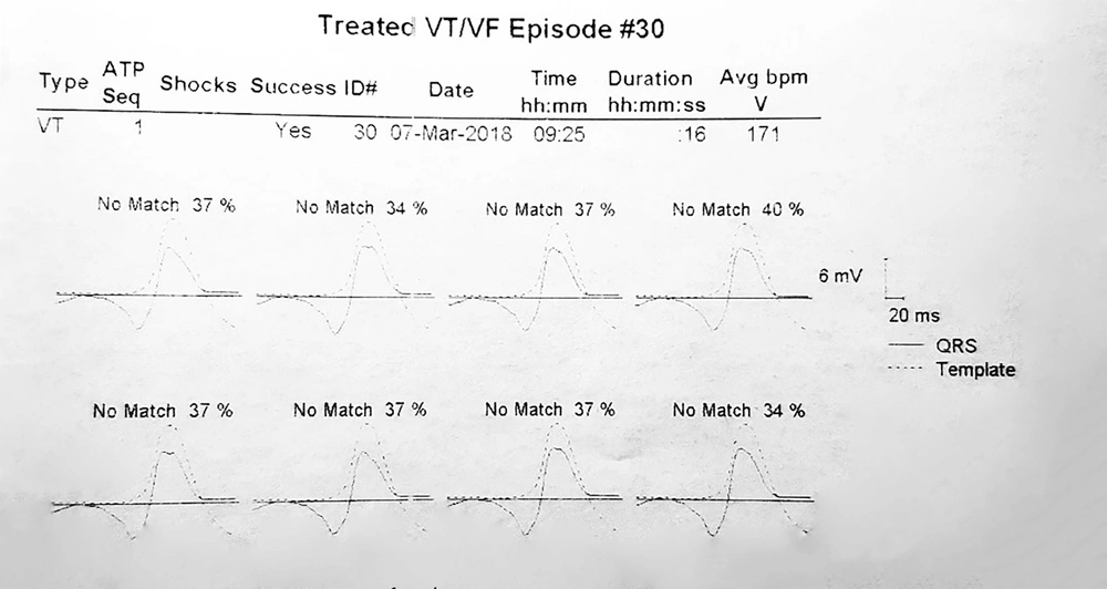Example of calculating the matching percentage. The average morphologic match between the last eight ventricular complexes during VT rhythm prior to detection and the stored native QRS morphology was defined as a matching percentage. According to this tracing, the matching percentage averages 37, 34, 37, 40, 37, 37, 37, and 34%. So it is equal to 36.6%. Example of calculating the matching percentage. The average morphologic match between the last eight ventricular complexes during VT rhythm prior to detection and the stored native QRS morphology was defined as a matching percentage. According to this tracing, the matching percentage averages 37, 34, 37, 40, 37, 37, 37, and 34%. So it is equal to 36.6%.