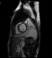 Eosinophilic Myocarditis: A Case Report and Literature Review