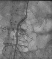 Cover image of the article: Chronic Mesenteric Ischemia, More Attention Is Needed in Cases with Prolonged Abdominal Pain: A Case Report and Brief Review