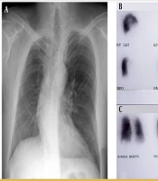 Isolated Unilateral Absence of Right Pulmonary Artery: Presenting with Dyspnea and Mimicking Pulmonary Embolism