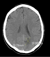 Cover image of the article: Concurrent Tricuspid Valve Endocarditis and Stroke Following Lung Transplantation: A Case Report