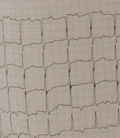 A Case Report of Pruritus as the Initial Symptom of Cardiac Thrombus Secondary to Atrial Fibrillation