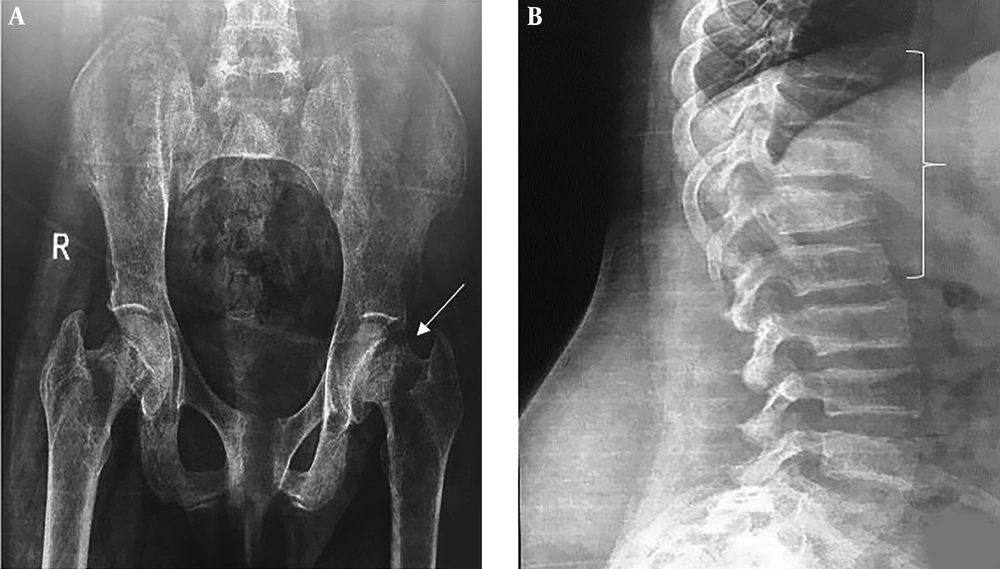 A, Pelvic plain radiography shows femoral neck fracture; B, thoracic and lumbar spine pain radiography demonstrated vertebral wedge fracture. A, Pelvic plain radiography shows femoral neck fracture; B, thoracic and lumbar spine pain radiography demonstrated vertebral wedge fracture.
