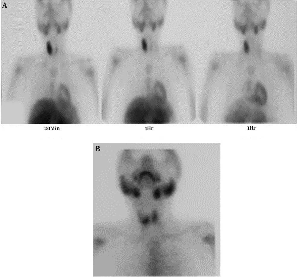 A, Parathyroid sestamibi scintigraphy in early (20 min) and delayed (1 and 3 hr.) phases; B, thyroid scintigraphy two days after parathyroid scan A, Parathyroid sestamibi scintigraphy in early (20 min) and delayed (1 and 3 hr.) phases; B, thyroid scintigraphy two days after parathyroid scan