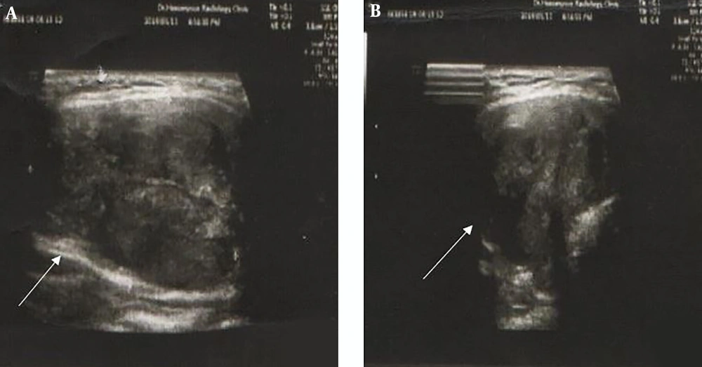 A, Ultrasonography shows large thyroidal nodule; B, intra nodular hyper and hypoechogenesity A, Ultrasonography shows large thyroidal nodule; B, intra nodular hyper and hypoechogenesity