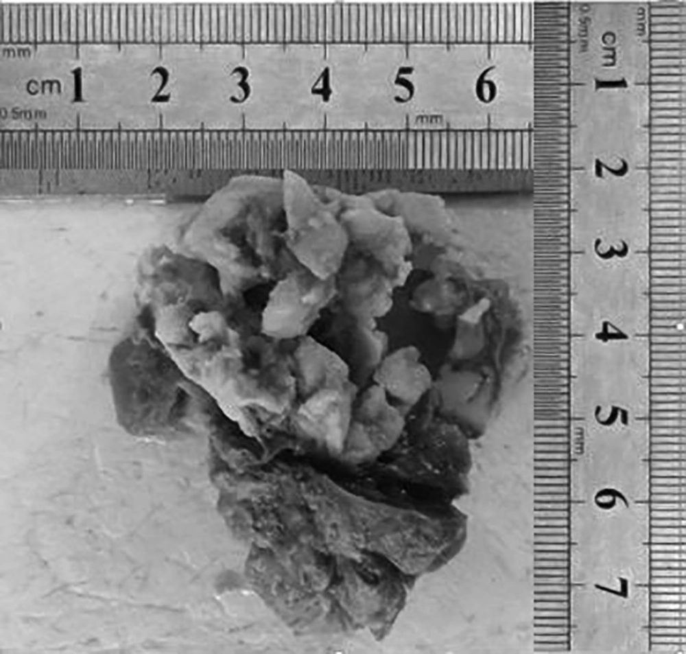Parathyroid gland and right thyroidal lobe Parathyroid gland and right thyroidal lobe