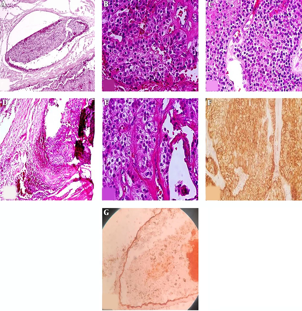 A, Vascular invasion in parathyroid carcinoma. Tumor cluster within the blood vessel lumina. (H & E, original magnification 200×); B, proliferated blood vessels in parathyroid carcinoma (H & E, original magnification 400×); C, uniform tumor cells presented as sheet (H & E, original magnification 200×); D, broad fibrous capsule invaded by tumor cells; E, nodules of tumor cells and fibrous band (H & E, original magnification 400x); F, CK positive in tumoral cells (IHC, original magnification 200×); G, CD34 is positive in blood vessel endothelium (orange arrow) which invaded by tumor cells (black arrow) (IHC staining, original magnification 200×). A, Vascular invasion in parathyroid carcinoma. Tumor cluster within the blood vessel lumina. (H & E, original magnification 200×); B, proliferated blood vessels in parathyroid carcinoma (H & E, original magnification 400×); C, uniform tumor cells presented as sheet (H & E, original magnification 200×); D, broad fibrous capsule invaded by tumor cells; E, nodules of tumor cells and fibrous band (H & E, original magnification 400x); F, CK positive in tumoral cells (IHC, original magnification 200×); G, CD34 is positive in blood vessel endothelium (orange arrow) which invaded by tumor cells (black arrow) (IHC staining, original magnification 200×).