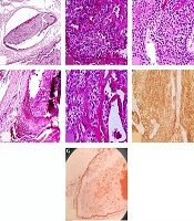 A Pediatric Parathyroid Carcinoma: An Unusual Clinical Presentation and Mini-review