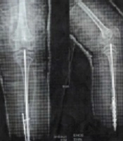Clinical Response to Treatment with Teriparatide in an Adolescent with Osteoporosis-Pseudoglioma Syndrome (OPPG): A Case Report