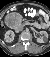 RET T244I Germline Variant Mutation in a Patient with Pancreatic Paraganglioma and Primary Hyperparathyroidism