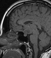 Malignant Endo-suprasellar Glioma: A Case Report and a Brief Review of the Literature