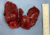 Therapeutic Plasma Exchange as a Bridging Therapy for the Definitive Treatment of a Patient with Graves’ Disease and Methimazole-Induced Liver Injury