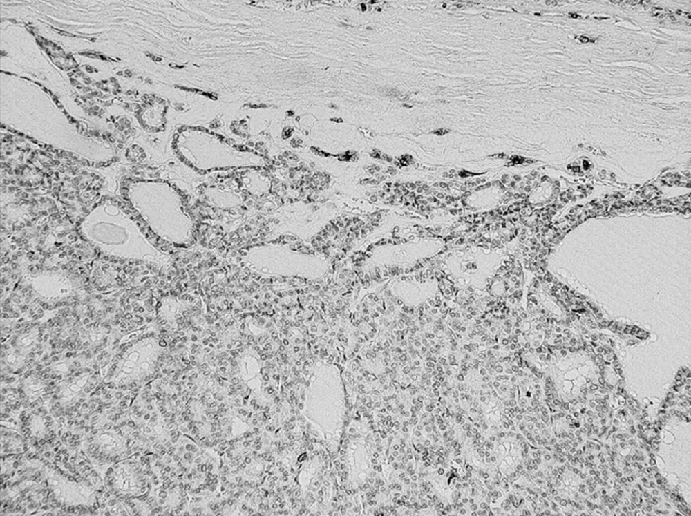 Expressions of sFN in Follicular Thyroid Carcinoma Magnification x 20