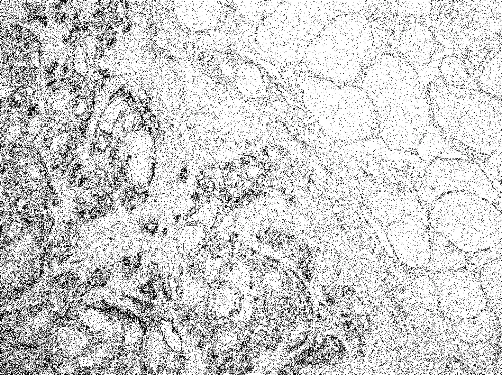 Expressions of sFN in Papillary Thyroid Carcinoma Magnification x 20
