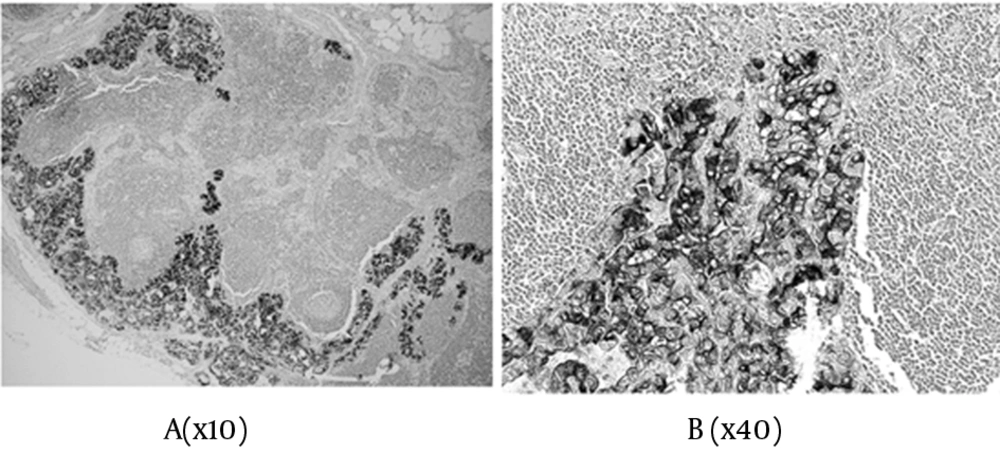 Expressions of sFN in Lymph Node Metastasis A) magnification x10; B) magnification x40