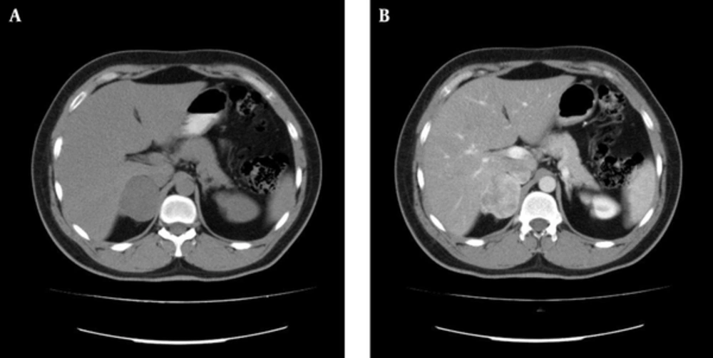 Un-Enhanced (A) and Contrast-Enhanced (B) Computed Tomography Scan Showed a Large Heterogenous Solid Mass in the Right Adrenal Gland Un-Enhanced (A) and Contrast-Enhanced (B) Computed Tomography Scan Showed a Large Heterogenous Solid Mass in the Right Adrenal Gland